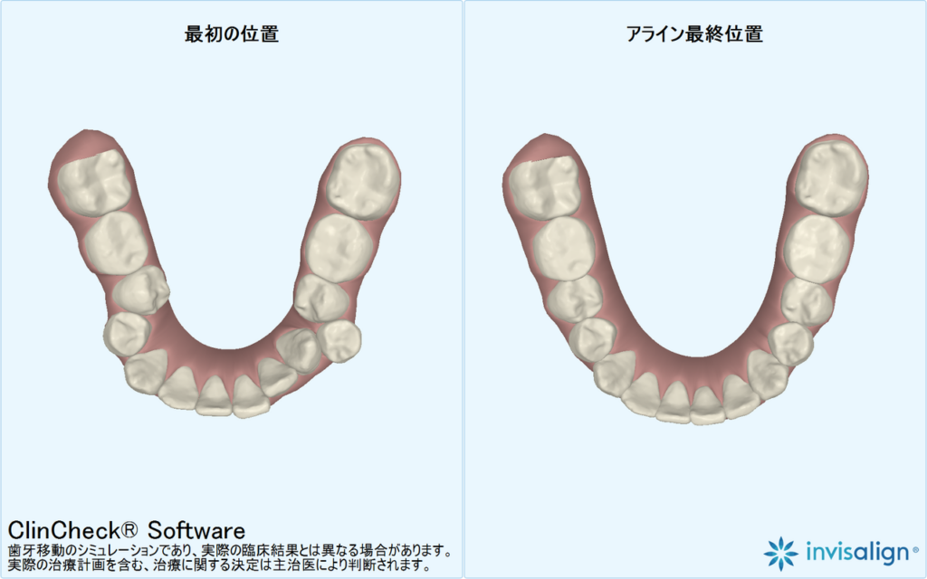 マウスピース矯正・インビザライン関連のイメージ写真