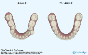 マウスピース矯正・インビザライン関連のイメージ写真