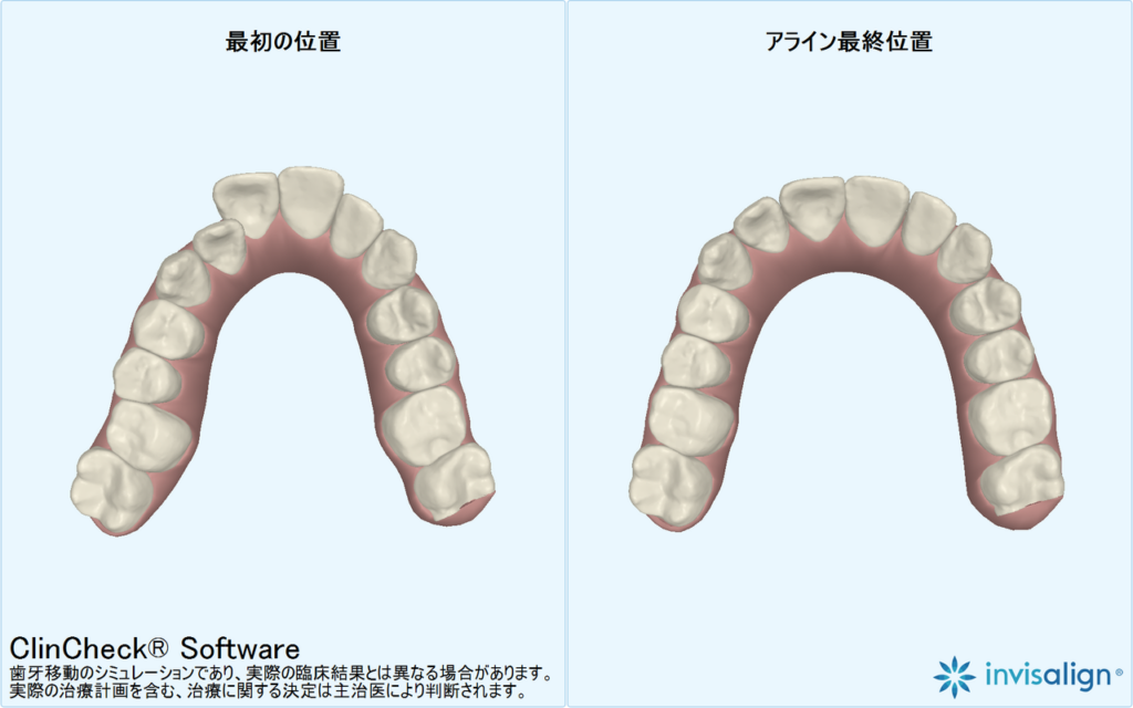 マウスピース矯正・インビザライン関連のイメージ写真